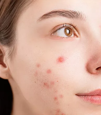 Deep Cleaning & Acne Treatment