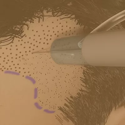 FUE hair transplant surgery on scalp, with surgical tool and marked donor hair area