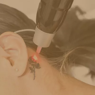 Laser tattoo removal for a small rose tattoo on the back of the neck near the ear
