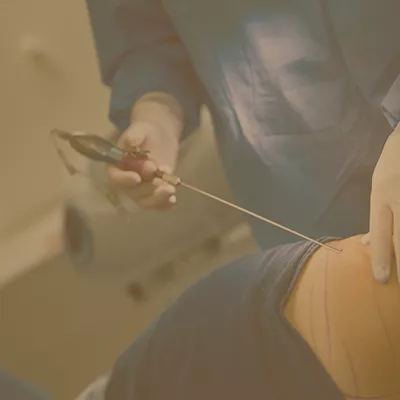 Surgeon performing liposuction surgery with a cannula on a marked patient